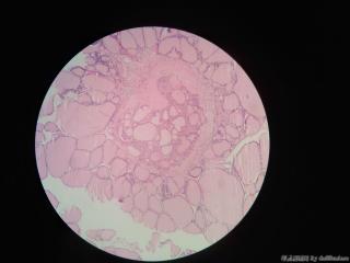 甲状腺嗜酸细胞镜下结节1mm，乳头状癌吗图3