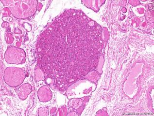 甲状腺组织，嗜酸细胞性结节？图6