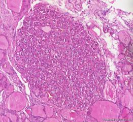 甲状腺组织，嗜酸细胞性结节？图3