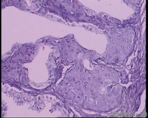 请教：前列腺增生伴尿路上皮化生？图9