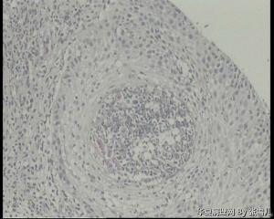 急！请老师看看食道粘膜糜烂怎么报？图6