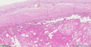 请老师们帮看看这个畸胎瘤的这些肉芽肿性区域是否有异常？图2