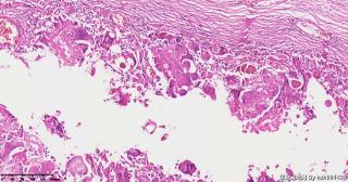 请老师们帮看看这个畸胎瘤的这些肉芽肿性区域是否有异常？图7