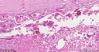 请老师们帮看看这个畸胎瘤的这些肉芽肿性区域是否有异常？图3