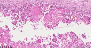 请老师们帮看看这个畸胎瘤的这些肉芽肿性区域是否有异常？图5