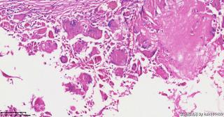 请老师们帮看看这个畸胎瘤的这些肉芽肿性区域是否有异常？图6