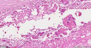 请老师们帮看看这个畸胎瘤的这些肉芽肿性区域是否有异常？图4
