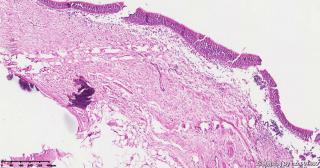 请老师们帮看看这个畸胎瘤的这些肉芽肿性区域是否有异常？图9