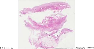请老师们帮看看这个畸胎瘤的这些肉芽肿性区域是否有异常？图1