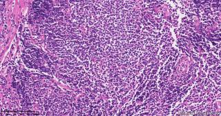 请老师们帮看看这些淋巴细胞，需要排除淋巴瘤吗？图16