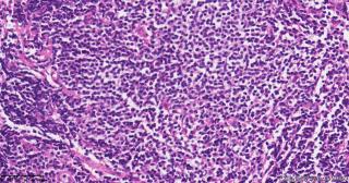 请老师们帮看看这些淋巴细胞，需要排除淋巴瘤吗？图17