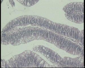 请老师看看，单位同事的直肠肿物，绒毛管状腺瘤伴轻—中度非典型增生吗？图6