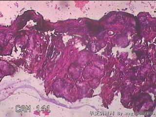 鼻腔新生物图18