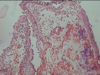 双侧鼻腔新生物图13