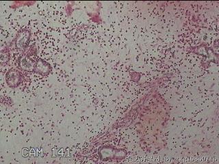 双侧鼻腔新生物图15