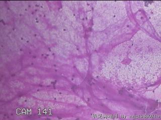 淡黄色胸水1ml图12