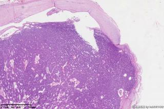 耳后包块，混合瘤？包膜上见肿瘤组织，请教老师们！图10