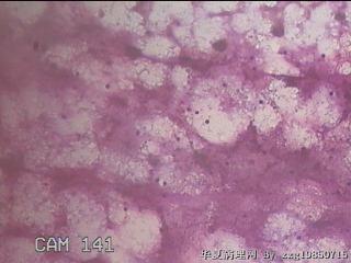 淡黄色胸水3ml图13