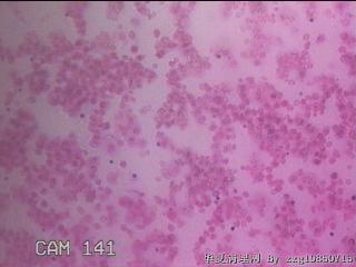 淡黄色胸水3ml图32