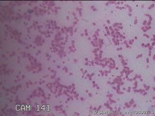 淡黄色胸水3ml图25