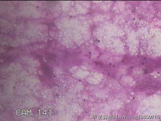 淡黄色胸水3ml图17