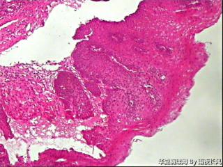 食管黏膜，够低级别吗？图17