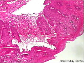 食管黏膜，够低级别吗？图3