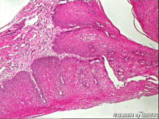 食管黏膜，够低级别吗？图1