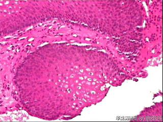 食管黏膜，够低级别吗？图5