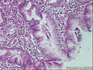 胃窦黏膜，请教老师，够低级别吗？图10