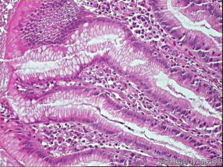 胃窦黏膜，请教老师，够低级别吗？图11