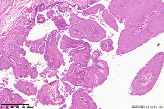 乳头状瘤？图11