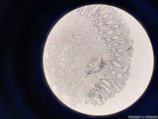 直肠距肛门5cm处赘生物图3