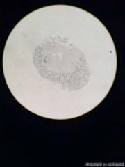 直肠距肛门5cm处赘生物图1