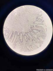 直肠距肛门5cm处赘生物图7