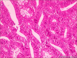 腺瘤伴低级别？图10