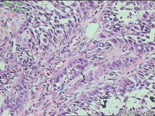 食管活检组织，够腺癌吗？图9