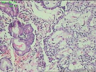 胃体活检组织，请教？图12