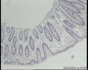 请教，结肠息肉怎么报？（重新上传图片了）图4