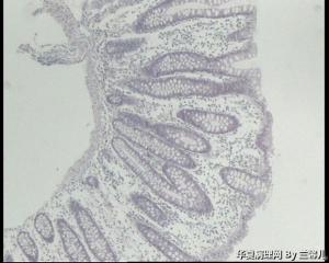 请教，结肠息肉怎么报？（重新上传图片了）图2