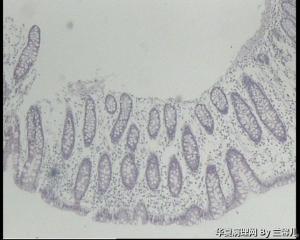 请教，结肠息肉怎么报？（重新上传图片了）图5