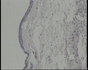 请教，右耳肿物，是耵聍腺瘤囊性变吗？还是囊性汗腺瘤？图2