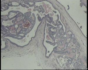 请教，右耳肿物，是耵聍腺瘤囊性变吗？还是囊性汗腺瘤？图16