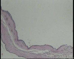 请教，右耳肿物，是耵聍腺瘤囊性变吗？还是囊性汗腺瘤？图4