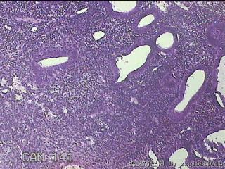 宫腔内膜组织图6