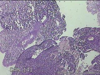 宫腔内膜组织图14