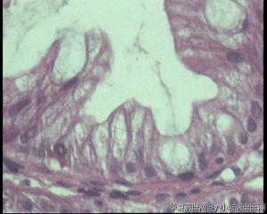 大肠多发性息肉，是增生性息肉还是锯齿状腺瘤？图6