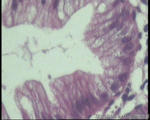 大肠多发性息肉，是增生性息肉还是锯齿状腺瘤？图2