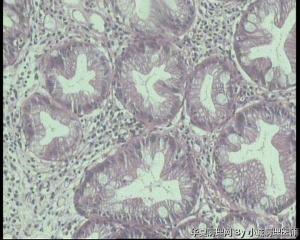 大肠多发性息肉，是增生性息肉还是锯齿状腺瘤？图4