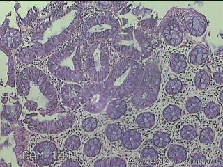乙状结肠粘膜图3